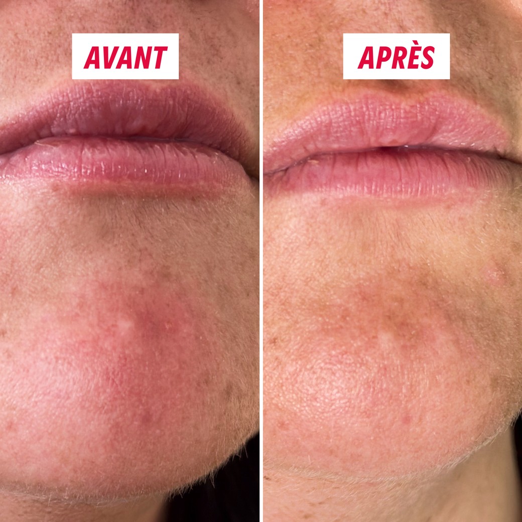 Détail des micropoints actifs du patch anti-bouton My SOS Beauty