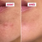 Texture du soin anti-boutons My SOS Beauty en gros plan
