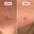 Avant après utilisation des patchs anti-boutons SOS My SOS Beauty