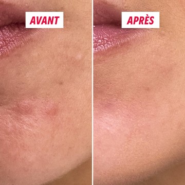 Texture du soin anti-boutons My SOS Beauty en gros plan
