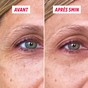 Résultat avant après gel tenseur yeux rides lissées