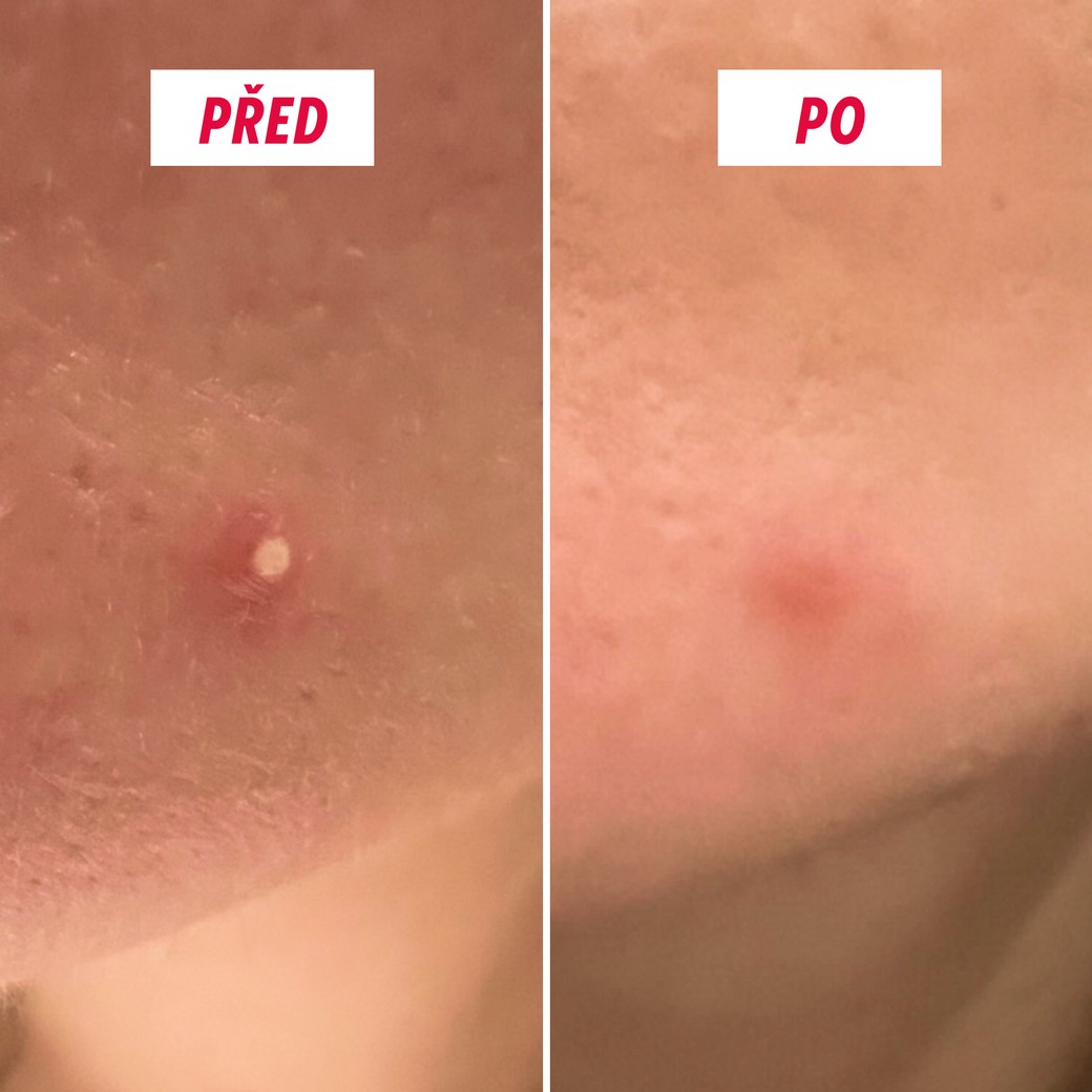 Hydrokoloidní náplasti na bílé pupínky z kitu SOS Patchs