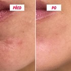 Textura aktivního krému proti pupínkům My SOS Beauty
