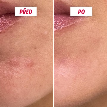 Textura aktivního krému proti pupínkům My SOS Beauty