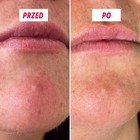 Struktura mikroigieł na powierzchni plastra My SOS Beauty