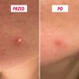 Plaster hydrokoloidowy naklejony punktowo na pryszcza