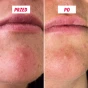 Struktura mikroigieł na powierzchni plastra My SOS Beauty