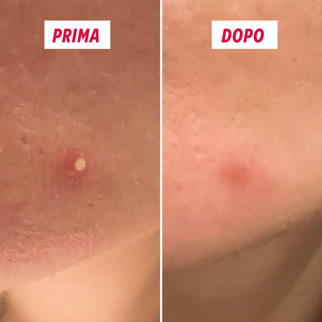 Cerotto idrocolloide My SOS Beauty applicato sulla pelle del viso