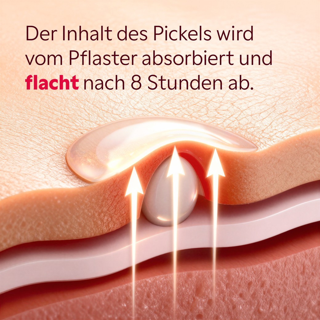 Hydrokolloid Pflaster auf der Haut aufgeklebt Anwendung
