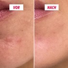 Anti-Pickel Creme My SOS Beauty Anwendung auf der Haut