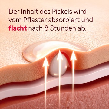 Hydrokolloid Pflaster auf der Haut aufgeklebt Anwendung