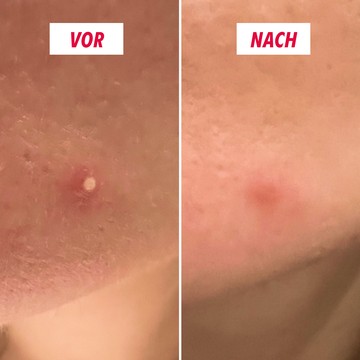 SOS Hydrokolloid-Patches 36 Stück Nahaufnahme