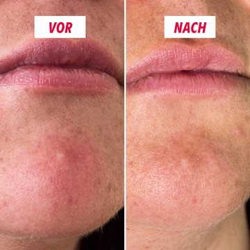 My SOS Beauty Micropoints Patches Frontalansicht mit Produktdetails