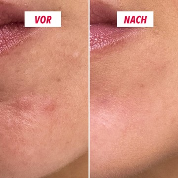 Anti-Pickel Creme My SOS Beauty Anwendung auf der Haut