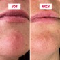 My SOS Beauty Micropoints Patches Frontalansicht mit Produktdetails