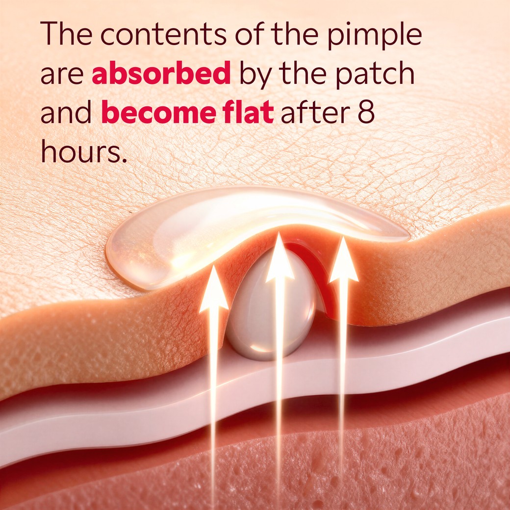 Hydrocolloid patch applied on skin absorbing a white pimple