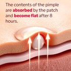 Hydrocolloid patch applied on skin absorbing a white pimple