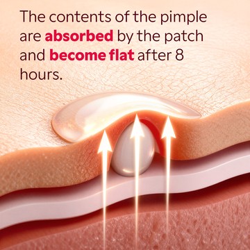 Hydrocolloid patch applied on skin absorbing a white pimple