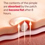 Hydrocolloid patch applied on skin absorbing a white pimple