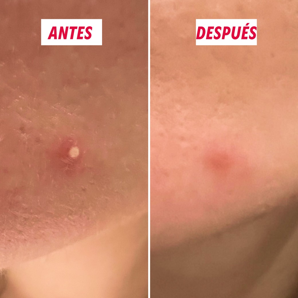 Parches hidrocoloides del Kit SOS Patchs para granos blancos