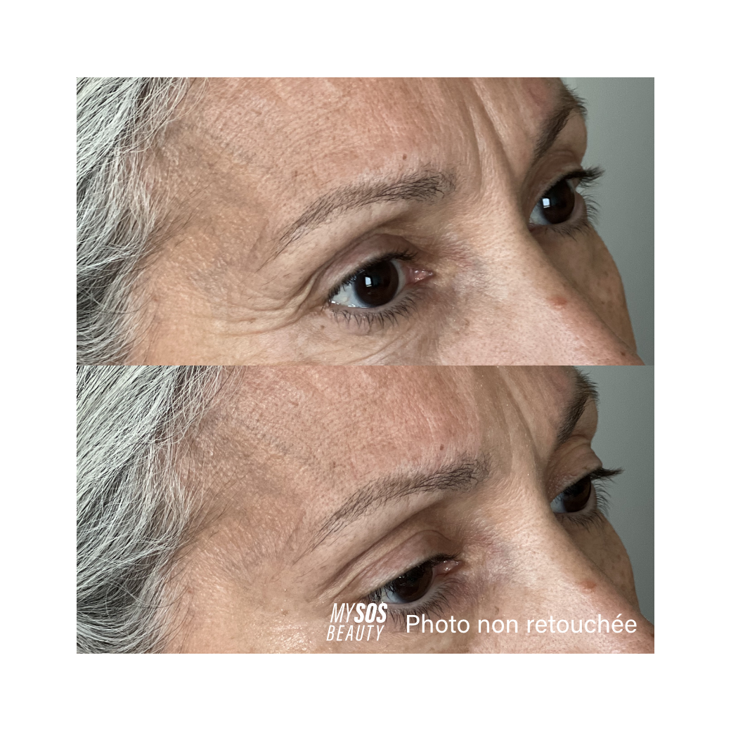 Contorno de ojos fotografiado antes y después de aplicar el gel