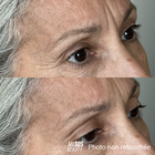 Contorno de ojos fotografiado antes y después de aplicar el gel