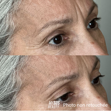 Contorno de ojos fotografiado antes y después de aplicar el gel